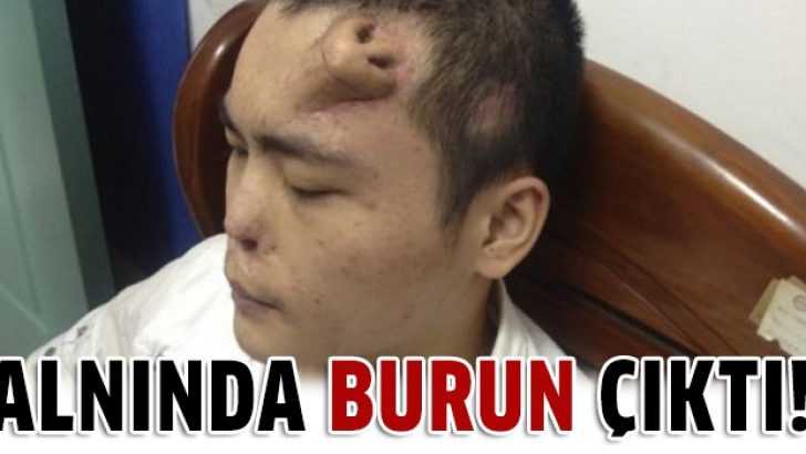 Alnından burun üretildi