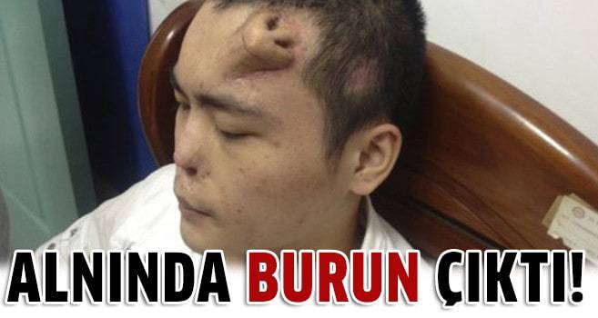 Alnından burun üretildi