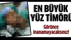 En büyük yüz tümörü ameliyatı yapıldı