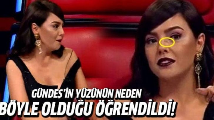 Ebru Gündeş’in yüzüne ne oldu?