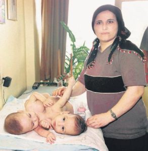 Bir başka Siyam annesi: Keşke o yıllarda Erdoğan olsaydı